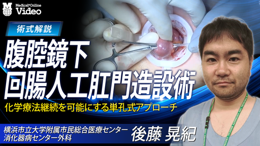 ロボット支援下腹腔鏡下幽門側胃切除術 D1＋郭清 Billroth-I法再建