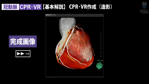 冠動脈造影の手技 冠動脈CT | 大分循環器病院医療法人輝心会 大分循環器病院