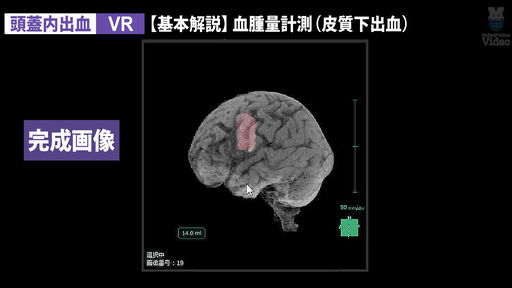 3D画像製作 頭蓋内出血（血腫量計測） VR ｜ Medical*Online Video