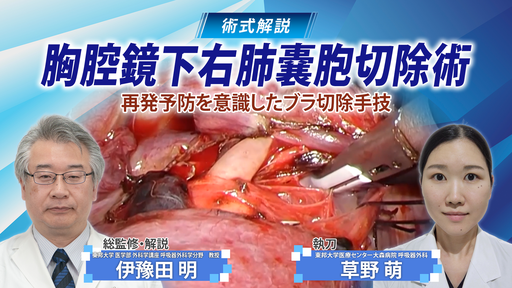 ロボット支援下噴門側胃切除（トンネル法） ｜ Medical*Online Video